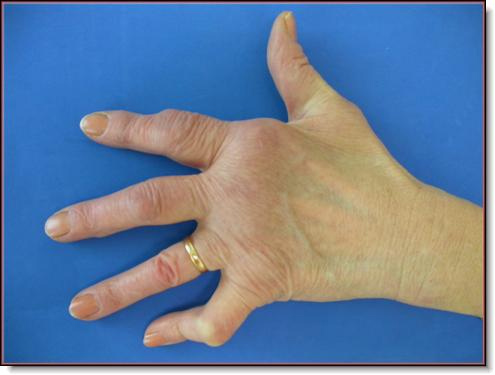 rheuma arthritis symptome hatékony tabletták a térd artrózisához