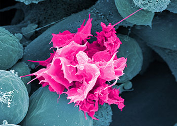Foto: Das Bild aus dem Rasterelektronenmikroskop zeigt eine Langerhanszelle (pink) bei der Auswanderung aus der Epidermis zu den Lymphknoten in 15.000facher Vergr&ouml;&szlig;erung. (Copyright: P. Stoitzner/K. Pfaller.)